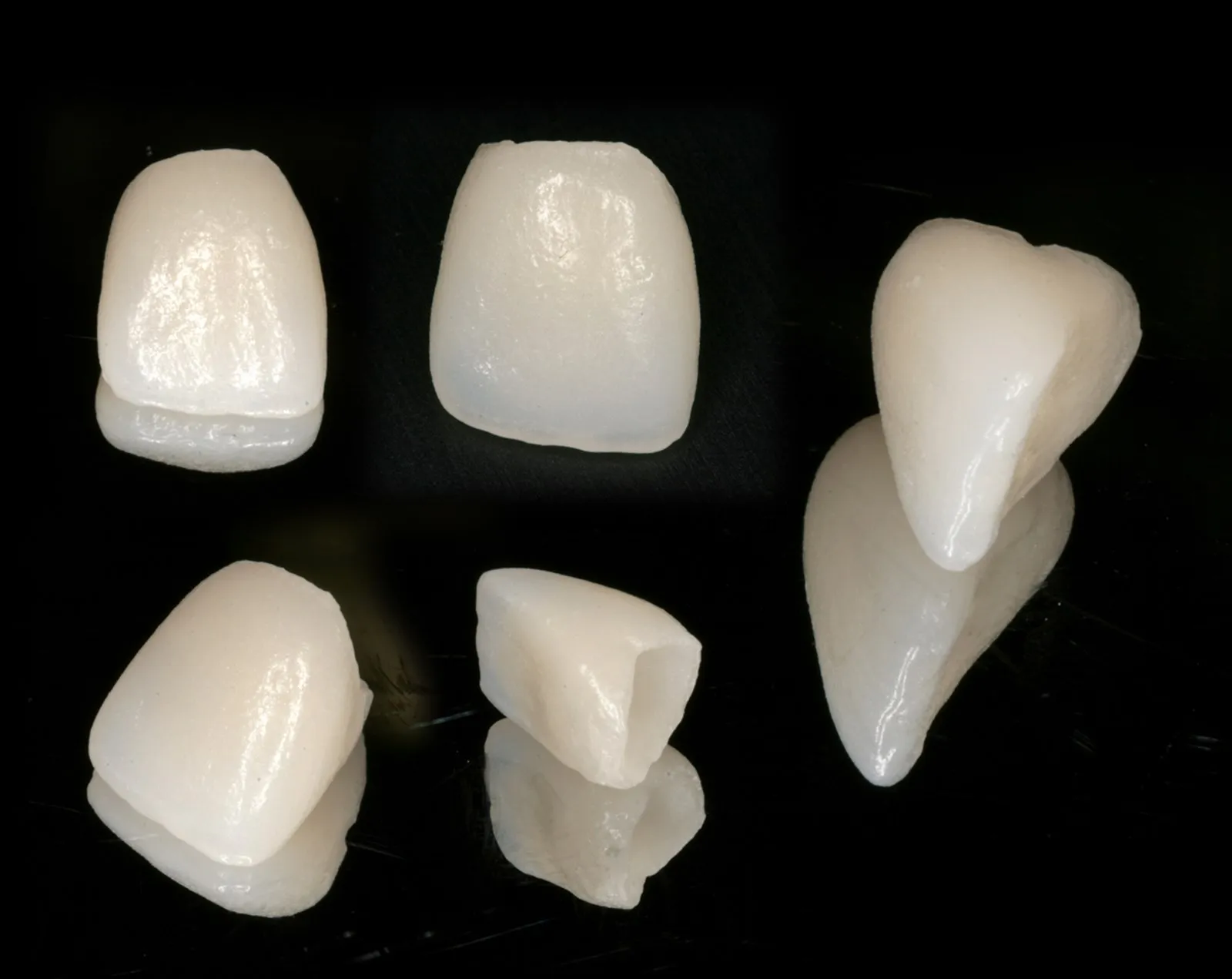 Coronas y carillas cerámicas realizadas en la Clínica Dental Ignacio Rodríguez Núñez