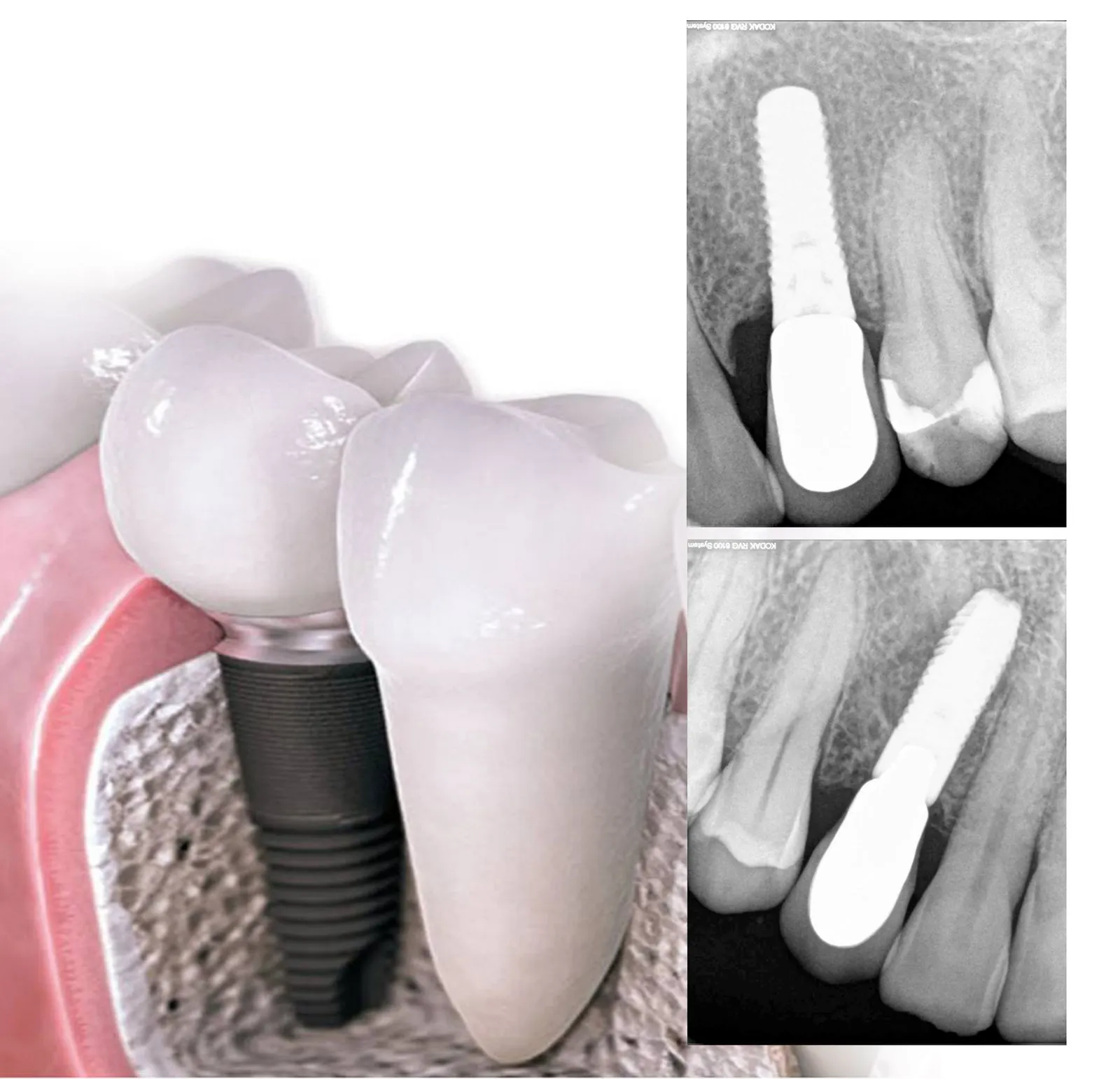 Ilustración de un implante dental y radiografías de casos de la Clínica Dental Ignacio Rodríguez Núñez