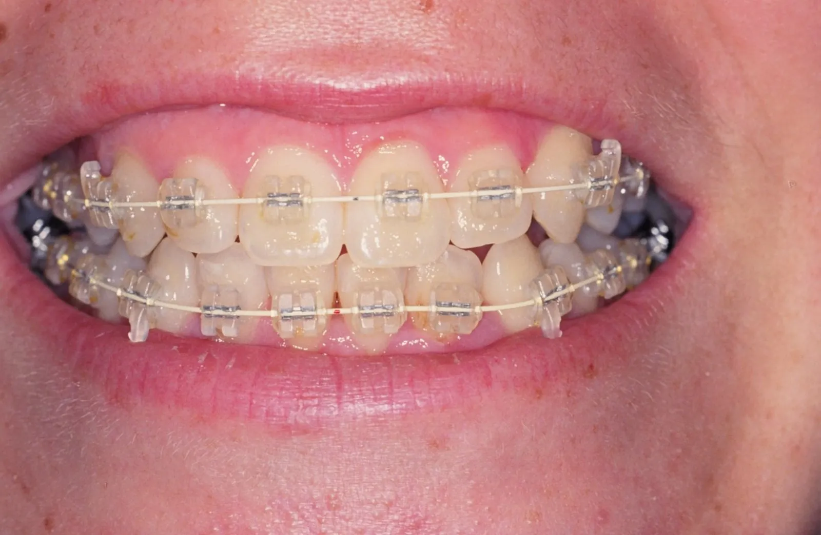 Dientes con brackets estéticos transparentes tratados en la Clínica Dental Ignacio Rodríguez Núñez
