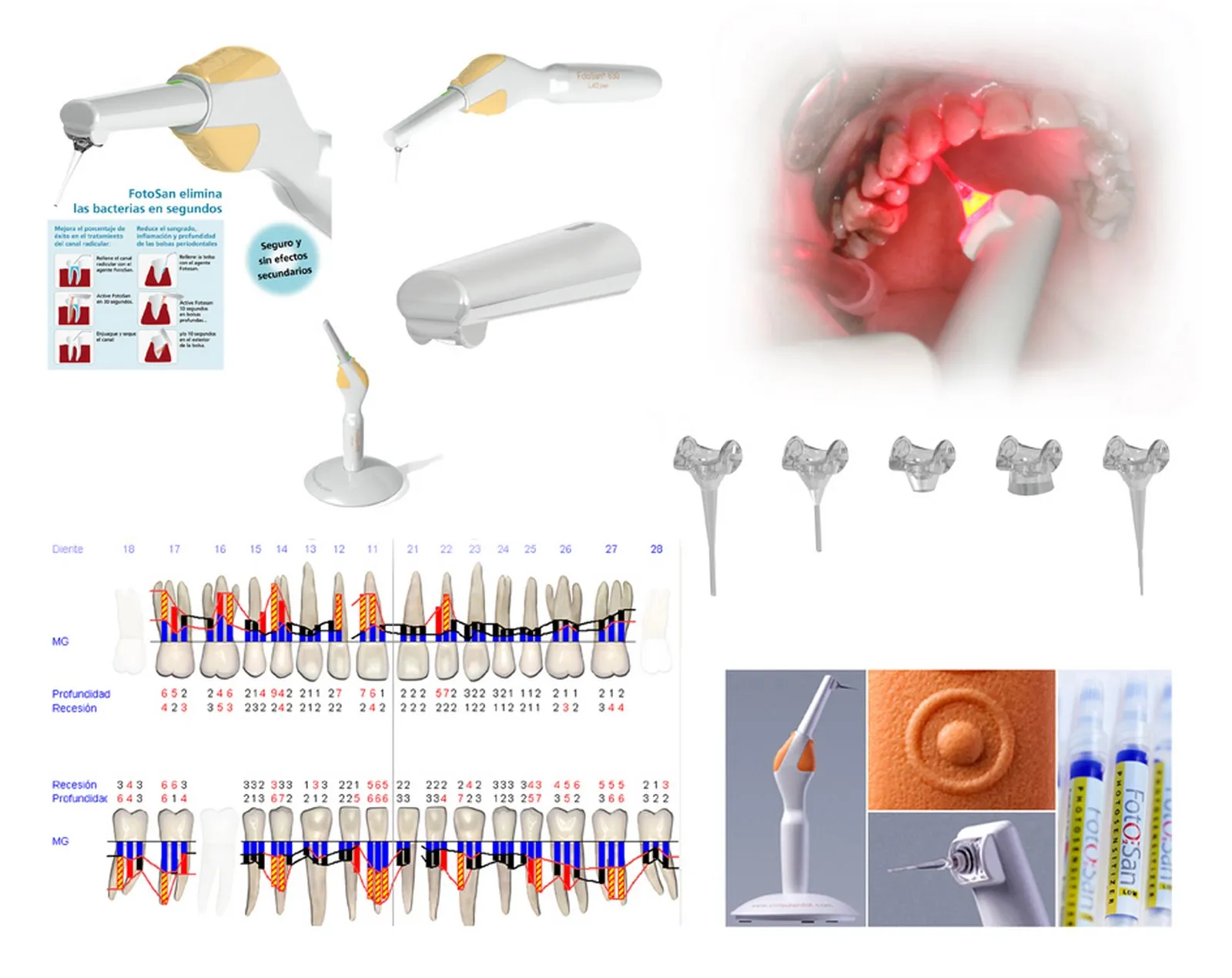 Terapia periodontal fotodinámica FotoSan empleada en la Clínica Dental Ignacio Rodríguez Núñez