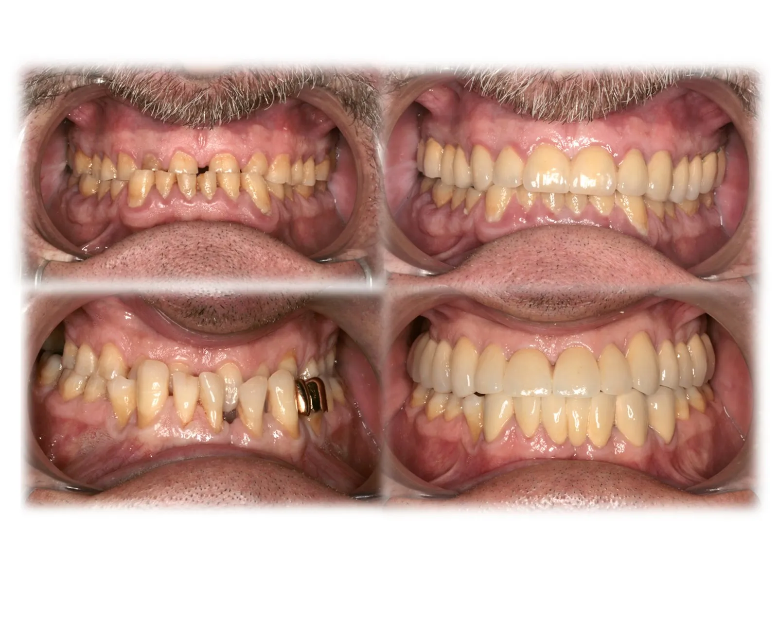 Antes y después de una rehabilitación oral completa en la Clínica Dental Ignacio Rodríguez Núñez